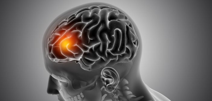 Novel brain stimulation treatment for severe depression proves highly effective
