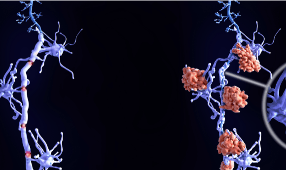 multiple sclerosis pregnancy